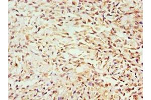 Immunohistochemistry of paraffin-embedded human breast cancer using ABIN7154587 at dilution of 1:100 (GEM antibody  (AA 1-150))