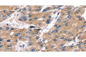 Immunohistochemistry of paraffin-embedded Human liver cancer tissue using SRGN Polyclonal Antibody at dilution 1:25 (SRGN antibody)