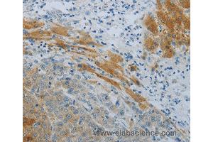 Immunohistochemistry of Human liver cancer using NPHS1 Polyclonal Antibody at dilution of 1:40 (Nephrin antibody)