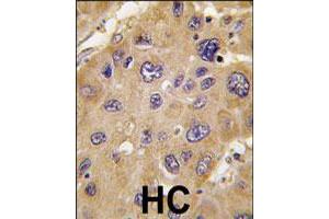 Formalin-fixed and paraffin-embedded human hepatocellular carcinoma reacted with ALDH6A1 polyclonal antibody  , which was peroxidase-conjugated to the secondary antibody, followed by DAB staining. (ALDH6A1 antibody  (C-Term))