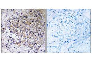 Immunohistochemistry analysis of paraffin-embedded human breast carcinoma tissue, using WASF3antibody.