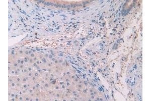 Detection of IL33 in Human Liver cancer Tissue using Monoclonal Antibody to Interleukin 33 (IL33) (IL-33 antibody  (AA 112-270))