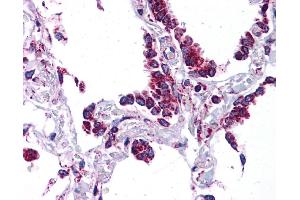 SFTPC antibody was used for immunohistochemistry at a concentration of 4-8 ug/ml. (Surfactant Protein C antibody  (N-Term))