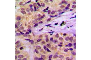 Immunohistochemical analysis of c-CBL (pY674) staining in human cervical cancer formalin fixed paraffin embedded tissue section.