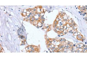 Immunohistochemistry of paraffin-embedded Human breast cancer using PTP4A2 Polyclonal Antibody at dilution of 1:30