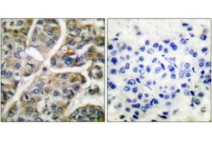 Immunohistochemistry analysis of paraffin-embedded human breast carcinoma tissue, using Granzyme B Antibody.
