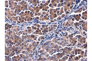 IHC-P Image Calpastatin antibody detects Calpastatin protein at cytoplasm in human lung cancer by immunohistochemical analysis. (Calpastatin antibody)