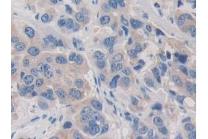 Detection of PDHX in Human Breast cancer Tissue using Polyclonal Antibody to Pyruvate Dehydrogenase Complex Component X (PDHX)