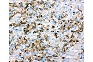 IHC-P: ALDH3A1 antibody testing of human gastric cancer tissue (ALDH3A1 antibody  (C-Term))