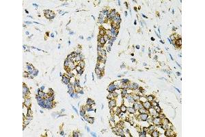 Immunohistochemistry of paraffin-embedded Human esophageal cancer using ADSS Polyclonal Antibody at dilution of 1:100 (40x lens). (ADSS antibody)