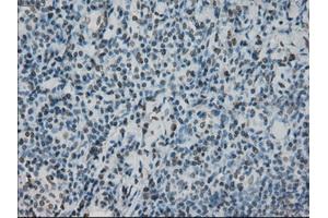 Immunohistochemical staining of paraffin-embedded lymphoma tissue using anti-PRKYmouse monoclonal antibody.