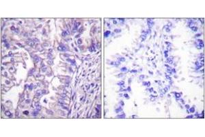 Immunohistochemistry analysis of paraffin-embedded human lung carcinoma tissue, using GAD1/2 Antibody. (GAD65+GAD67 (AA 545-594) antibody)