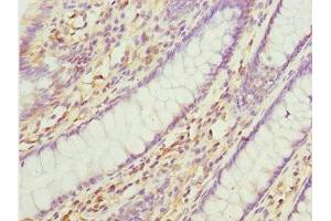 Immunohistochemistry of paraffin-embedded human colon cancer using ABIN7165175 at dilution of 1:100 (TNRC5 antibody  (AA 31-278))