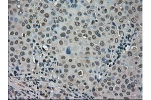 Immunohistochemical staining of paraffin-embedded Carcinoma of kidney tissue using anti-LDHAmouse monoclonal antibody. (Lactate Dehydrogenase A antibody)
