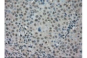 Immunohistochemical staining of paraffin-embedded Carcinoma of kidney tissue using anti-LDHAmouse monoclonal antibody. (Lactate Dehydrogenase A antibody)