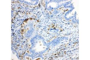 IHC-P: TRPC6 antibody testing of human intestinal cancer tissue (TRPC6 antibody  (Middle Region))