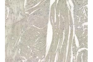 ABIN6257159 and ABIN6275121 at 1/100 staining human tongue carcinoma by IHC-P. (EIF3F antibody  (Internal Region))
