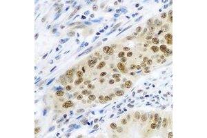 Immunohistochemical analysis of Cullin 4A staining in human colon cancer formalin fixed paraffin embedded tissue section. (Cullin 4A antibody)
