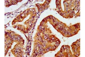 IHC image of ABIN7166879 diluted at 1:600 and staining in paraffin-embedded human endometrial cancer performed on a Leica BondTM system. (PNPO antibody  (AA 114-207))