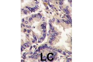 Formalin-fixed and paraffin-embedded human lung carcinoma tissue reacted with VEGFC polyclonal antibody  , which was peroxidase-conjugated to the secondary antibody, followed by DAB staining. (VEGFC antibody  (Internal Region))