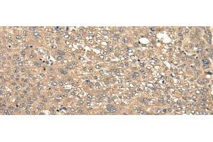Immunohistochemistry of paraffin-embedded Human liver cancer tissue using CIR1 Polyclonal Antibody at dilution of 1:40(x200) (CIR1 antibody)