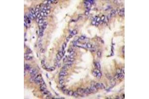 Formalin-fixed and paraffin-embedded human lung carcinoma tissue reacted with STK9 Antibody (C-term) , which was peroxidase-conjugated to the secondary antibody, followed by DAB staining. (CDKL5 antibody  (C-Term))