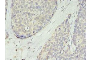 Immunohistochemistry of paraffin-embedded human gastric cancer using ABIN7173225 at dilution of 1:100 (TMEM45A antibody  (AA 171-217))