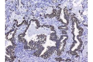 IHC analysis of Cytokeratin 19 using anti-Cytokeratin 19 antibody (ABIN3043288). (Cytokeratin 19 antibody  (C-Term))