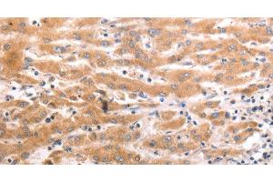Immunohistochemistry of paraffin-embedded Human liver cancer tissue using HCRTR1 Polyclonal Antibody at dilution 1:70 (HCRTR1 antibody)