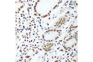 Immunohistochemical analysis of DR1 staining in human gastric cancer formalin fixed paraffin embedded tissue section. (DR1 antibody)