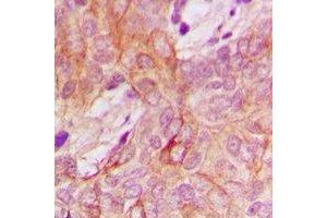 Immunohistochemical analysis of PPM1K staining in human breast cancer formalin fixed paraffin embedded tissue section. (PPM1K antibody)