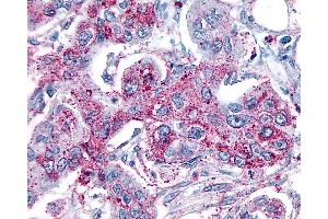 Anti-GRM8 / MGLUR8 antibody IHC of human Pancreas, Carcinoma. (GRM8 antibody  (N-Term))