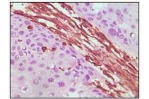 Immunohistochemical analysis of paraffin-embedded human lung carcinoma tissue, showing cytoplasmic localization using Vimentin antibody with DAB staining.