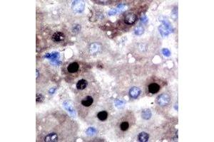 Immunohistochemical analysis of BCL11A staining in human liver cancer formalin fixed paraffin embedded tissue section. (BCL11A antibody)