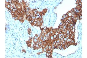 Formalin-fixed, paraffin-embedded human Breast Carcinoma stained with HER-2 Monospecific Mouse Monoclonal Antibody (ERBB2/3257). (ErbB2/Her2 antibody  (AA 311-462))