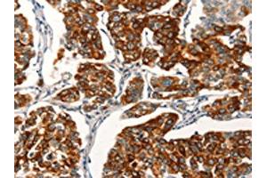 The image on the left is immunohistochemistry of paraffin-embedded Human breast cancer tissue using ABIN7189718(AGO4 Antibody) at dilution 1/25, on the right is treated with synthetic peptide.