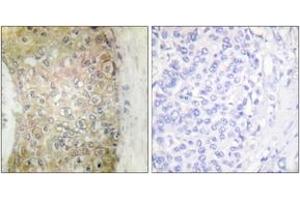Immunohistochemistry analysis of paraffin-embedded human breast carcinoma tissue, using HSP20 (Ab-16) Antibody.