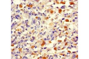 Immunohistochemistry of paraffin-embedded human melanoma using ABIN7173512 at dilution of 1:100 (TRMT112 antibody  (AA 1-125))