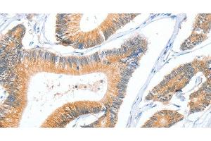 Immunohistochemistry of paraffin-embedded Human colon cancer using ACY3 Polyclonal Antibody at dilution of 1:35 (Aminoacylase 3 antibody)