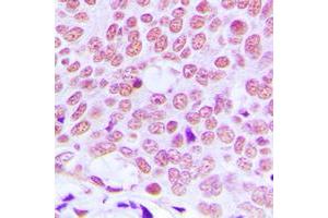 Immunohistochemical analysis of c-Jun staining in human breast cancer formalin fixed paraffin embedded tissue section.