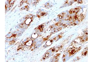 Formalin-fixed, paraffin-embedded human Colon Carcinoma stained with CEA Mouse Monoclonal Antibody (CEA31). (CEACAM5 antibody)