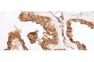 Immunohistochemistry of paraffin-embedded Human thyroid cancer tissue using HOXB9 Polyclonal Antibody at dilution of 1:45(x200) (HOXB9 antibody)