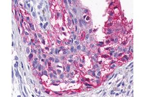 Anti-HTR4 / 5-HT4 Receptor antibody IHC of human Skin, Melanoma. (Serotonin Receptor 4 antibody  (Cytoplasmic Domain))