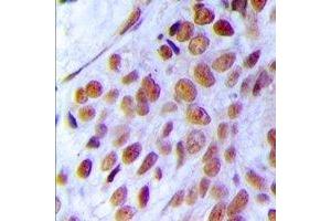 Immunohistochemical analysis of MRE11 staining in human breast cancer formalin fixed paraffin embedded tissue section.