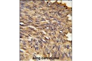 Formalin-fixed and paraffin-embedded human lung carcinoma reacted with HDLBP Antibody (Center), which was peroxidase-conjugated to the secondary antibody, followed by DAB staining. (HDLBP antibody  (AA 764-791))