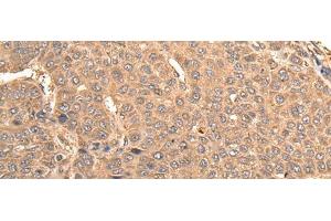 Immunohistochemistry of paraffin-embedded Human liver cancer tissue using BUD31 Polyclonal Antibody at dilution of 1:75(x200) (BUD31 antibody)
