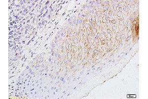 Formalin-fixed and paraffin embedded mouse foot tumor labeled with Anti-CCL21/6CKINE Polyclonal Antibody, Unconjugated (ABIN732698) followed by conjugation to the secondary antibody and DAB staining (CCL21 antibody  (AA 24-134))