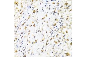 Immunohistochemistry of paraffin-embedded human kidney cancer using SUMO4 Antibody. (SUMO4 antibody)
