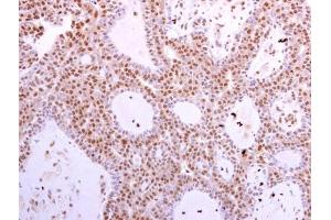 CDK6 antibody [N1C3] detects CDK6 protein at cytoplasm and nucleus in human lung adenocarcinoma by immunohistochemical analysis. (CDK6 antibody)