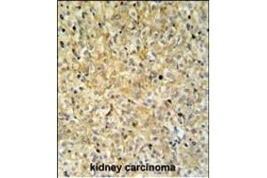 PK1IP1L Antibody (Center) (ABIN653686 and ABIN2843011) IHC analysis in forlin fixed and paraffin embedded kidney carcino followed by peroxidase conjugation of the secondary antibody and DAB staining. (MAPK1IP1L antibody  (AA 108-137))